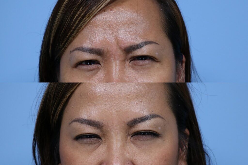 This woman is frowning in both the before and after photo. In the lower photo which is the same woman after a Botox injection, you can see how her muscles have relaxed and thus do not show lines.