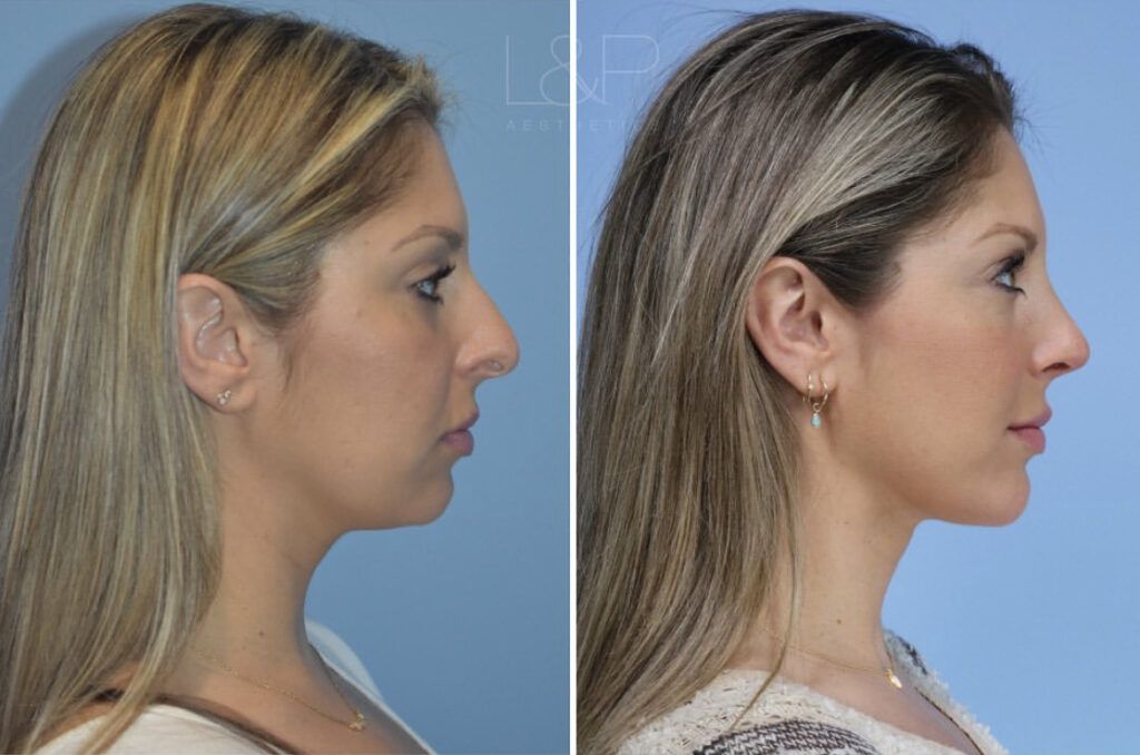 Before/After of Midline Necklift patient at L&P Aesthetics, Palo Alto