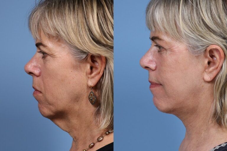 Before and after mini facelift surgery in Palo Alto, CA