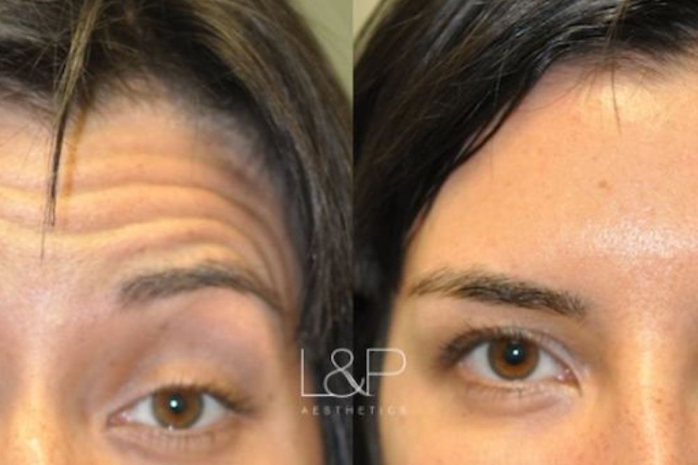 Before & after Wrinkle Relaxe treatment