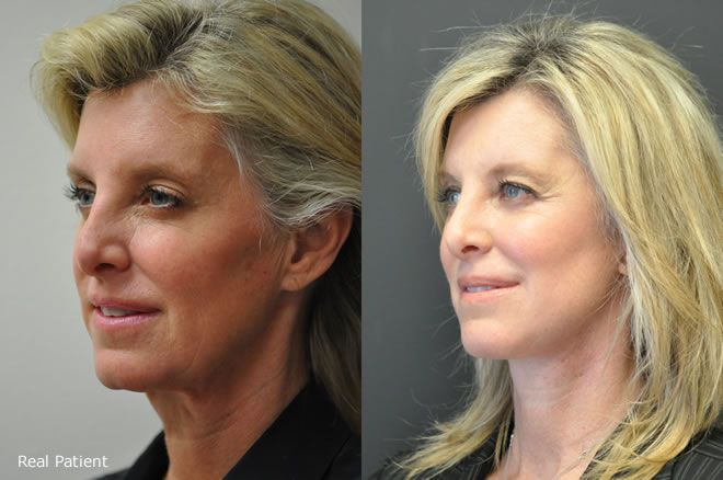 Cathy Before After treatment