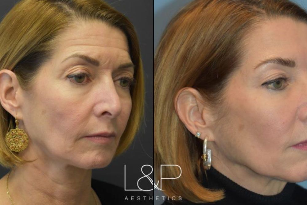 Before & after Facial Fillers treatment