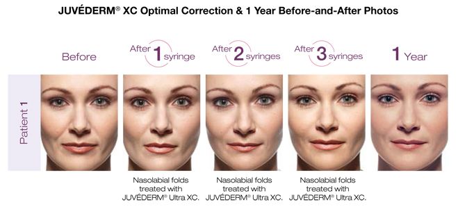 JUVÉDERM XC Optimal Correction 1 year before and after treatment