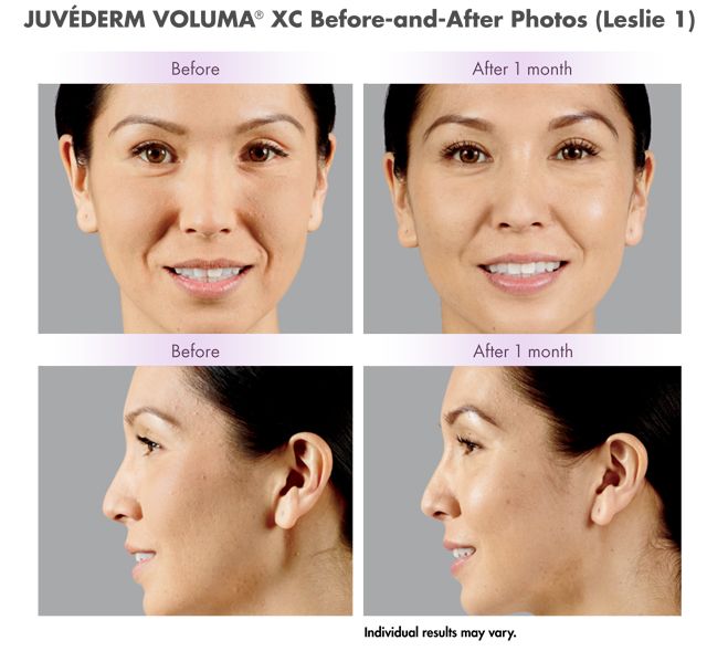 JUVÉDERM VOLUMA XC Before and after treatment