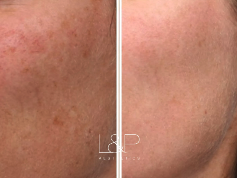 HALO™ Hybrid Fractional Laser before and after treatment
