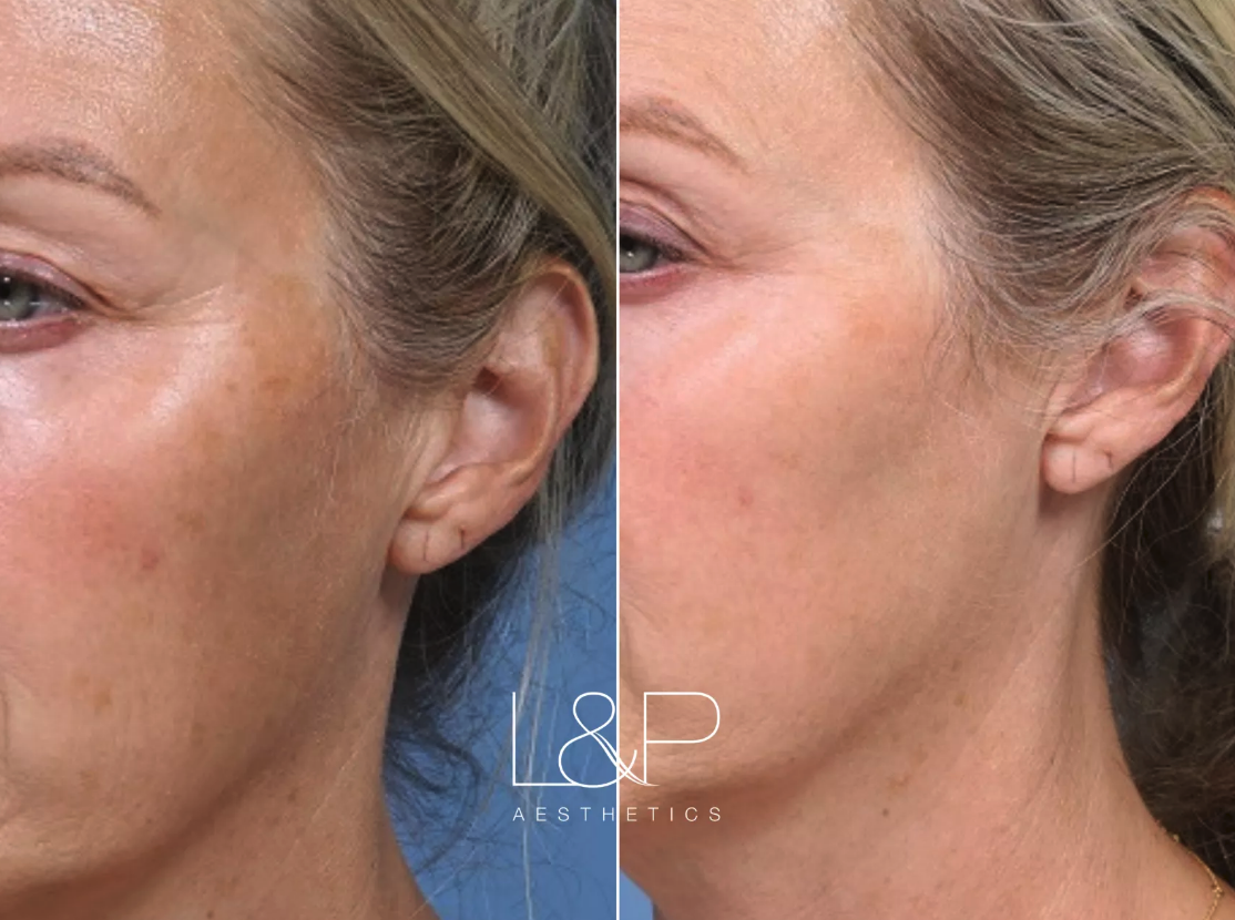 HALO™ Hybrid Fractional Laser before and after treatment