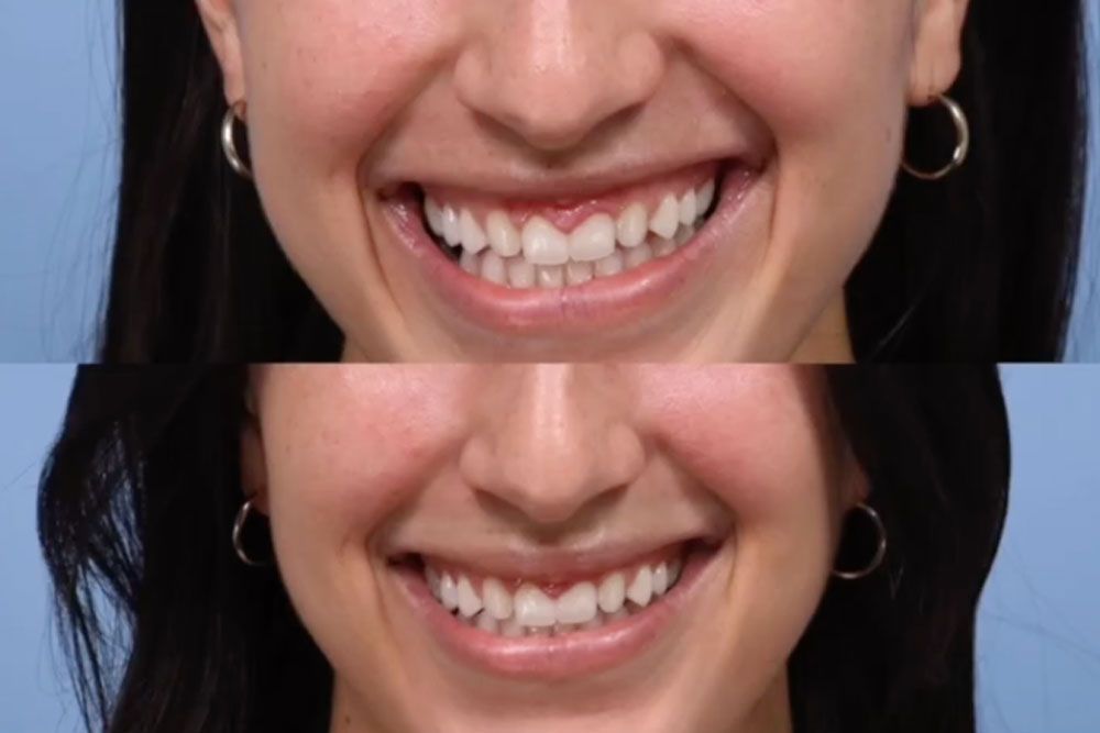 Before & after Lip treatment