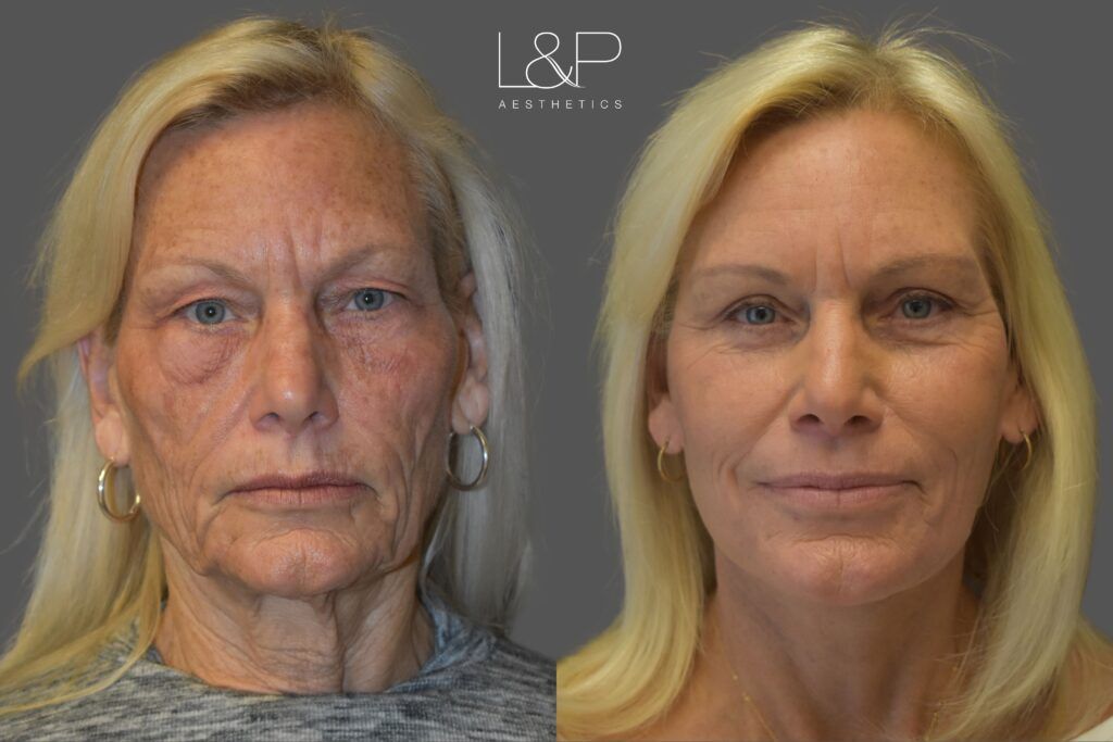 Facelift Neck Lift before and after treatment in the Bay Area by Drs. Lieberman & Parikh
