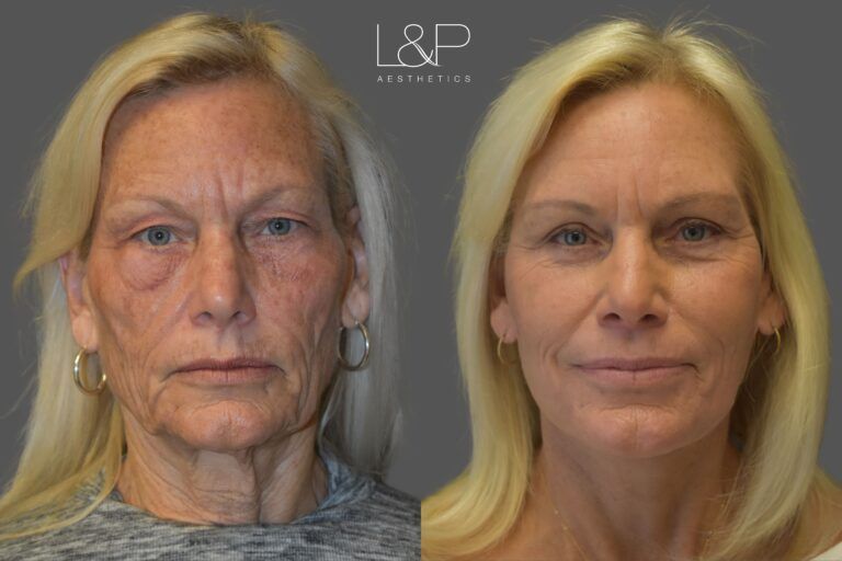Facelift Neck Lift before and after treatment in the Bay Area by Drs. Lieberman & Parikh