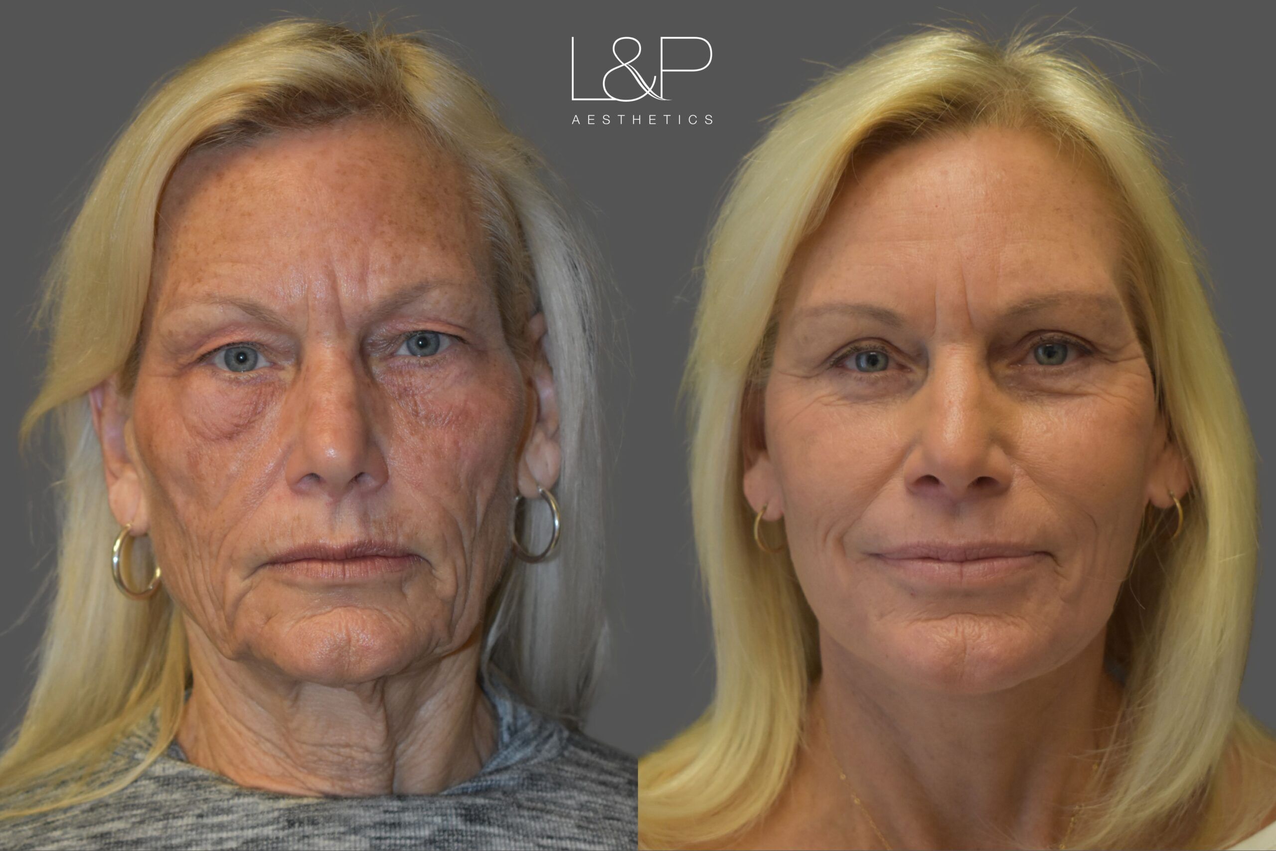 Facelift Neck Lift before and after treatment in the Bay Area by Drs. Lieberman & Parikh