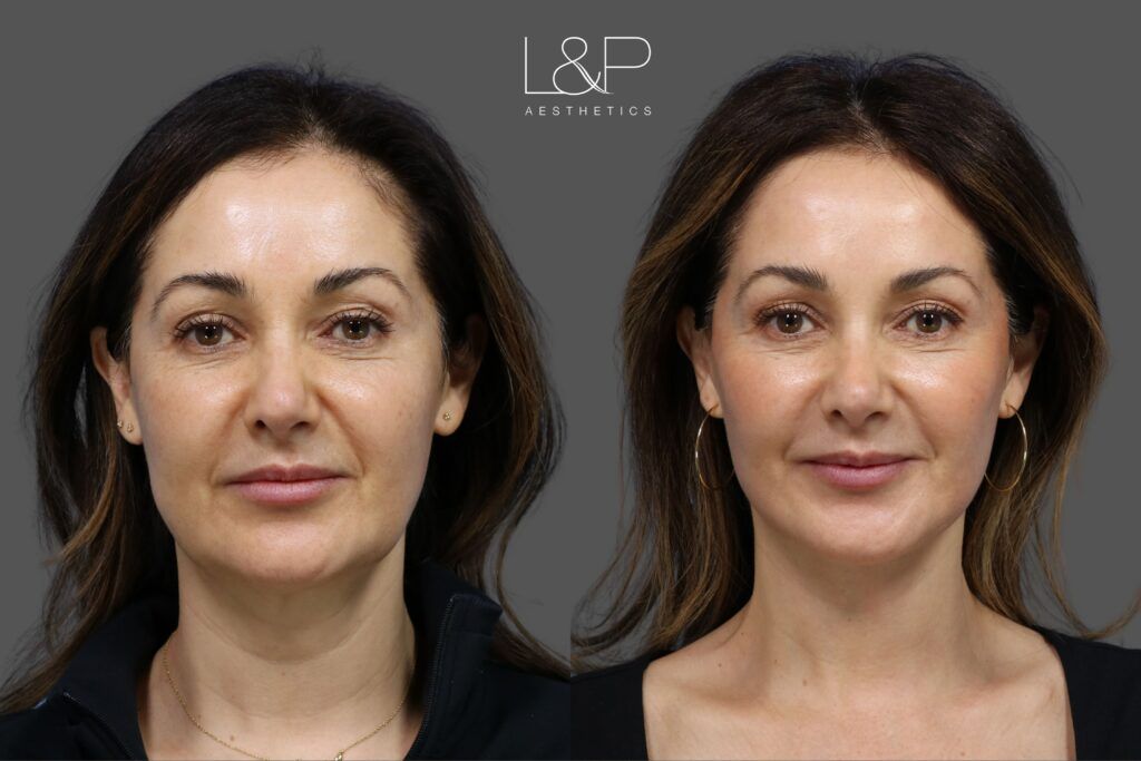 Before and after a facelift by L&P Aesthetics - a gorgeous 50 year old woman