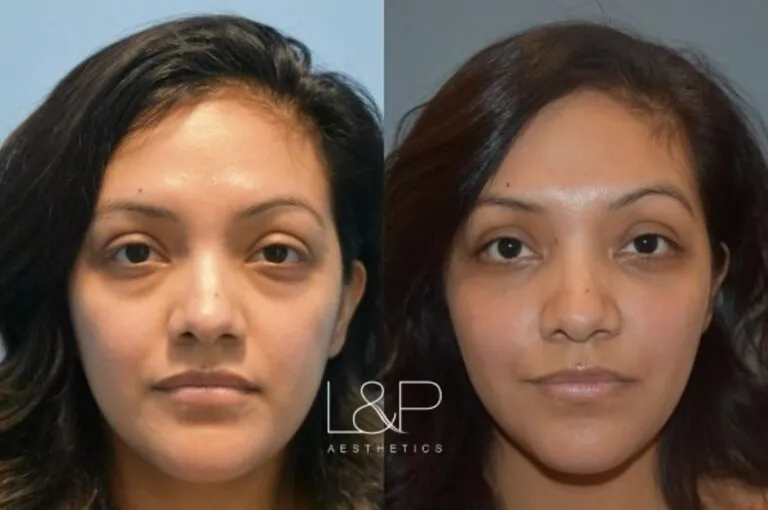 Blepharoplasty before and after treatment in Palo Alto, California