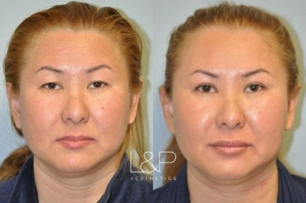 Blepharoplasty before and after treatment