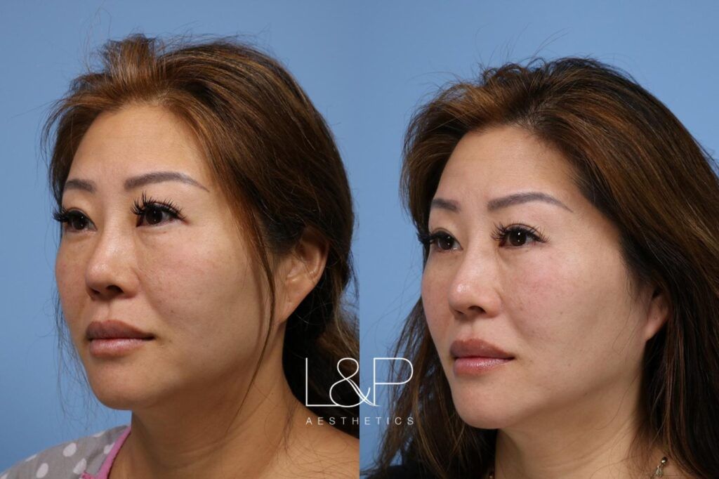 Blepharoplasty before and after treatment