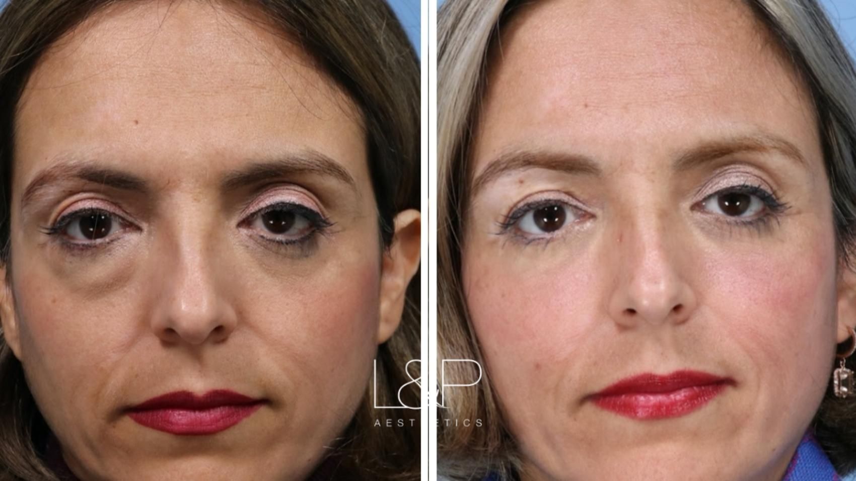 Blepharoplasty before and after treatment