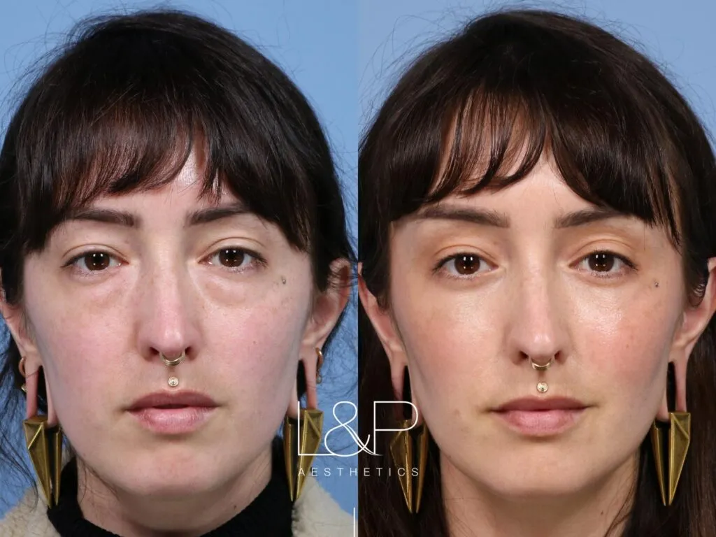 Blepharoplasty before and after treatment in the Bay Area