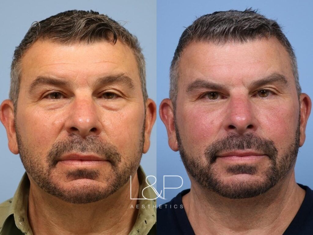 Blepharoplasty before and after treatment