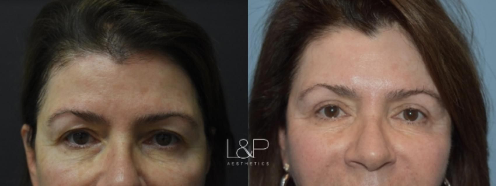 Blepharoplasty before and after treatment