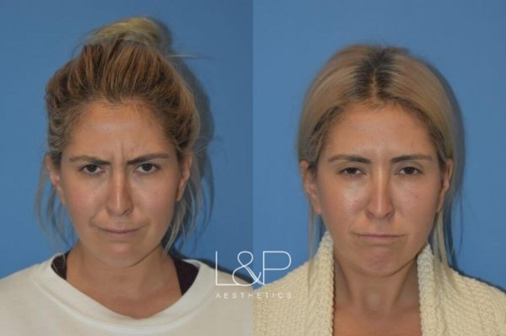 Botox Cosmetic before and after treatment