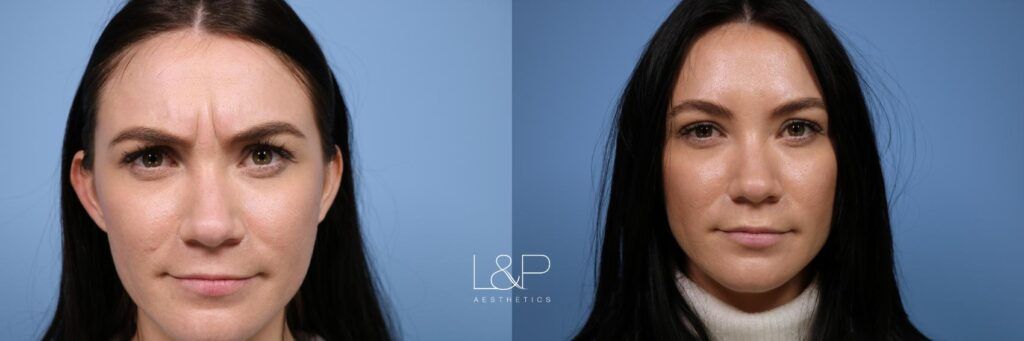 Botox Cosmetic before and after treatment