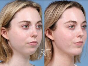 Buccal Fat Removal before and after treatment