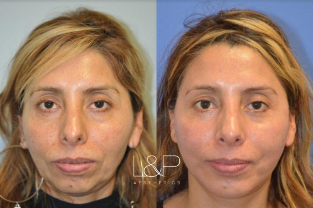 Chin Augmentation before and after treatment
