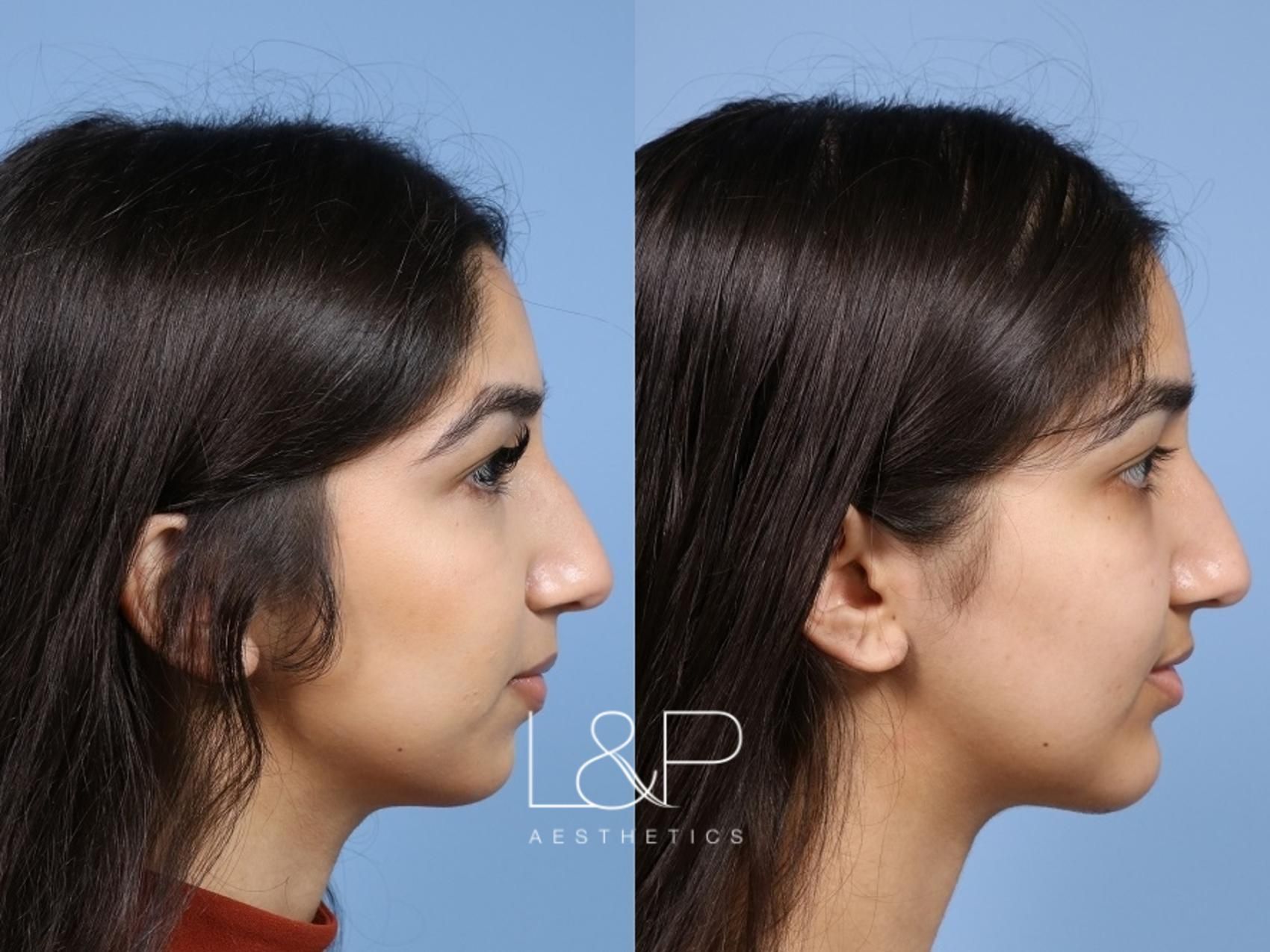 Chin Augmentation before and after treatment