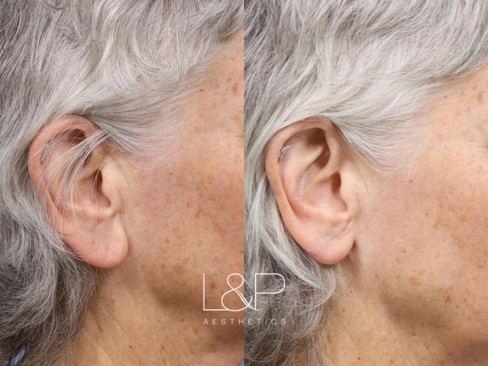 Earlobe Repair before and after treatment