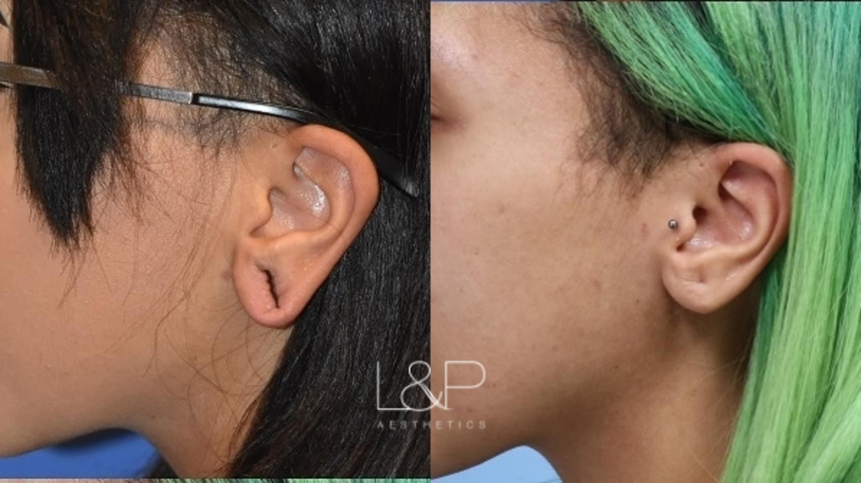 Earlobe Repair before and after treatment