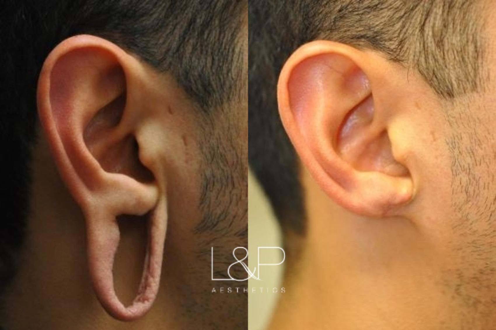 Earlobe Repair before and after treatment