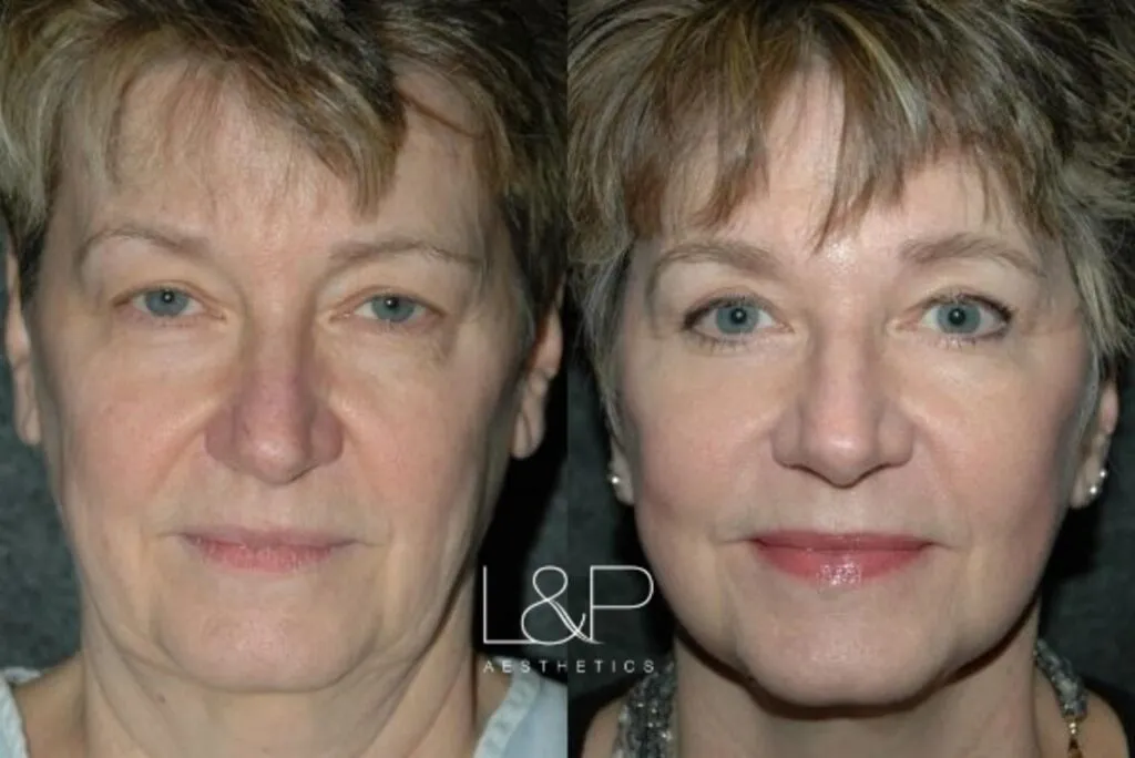 Facelift Neck Lift before and after treatment
