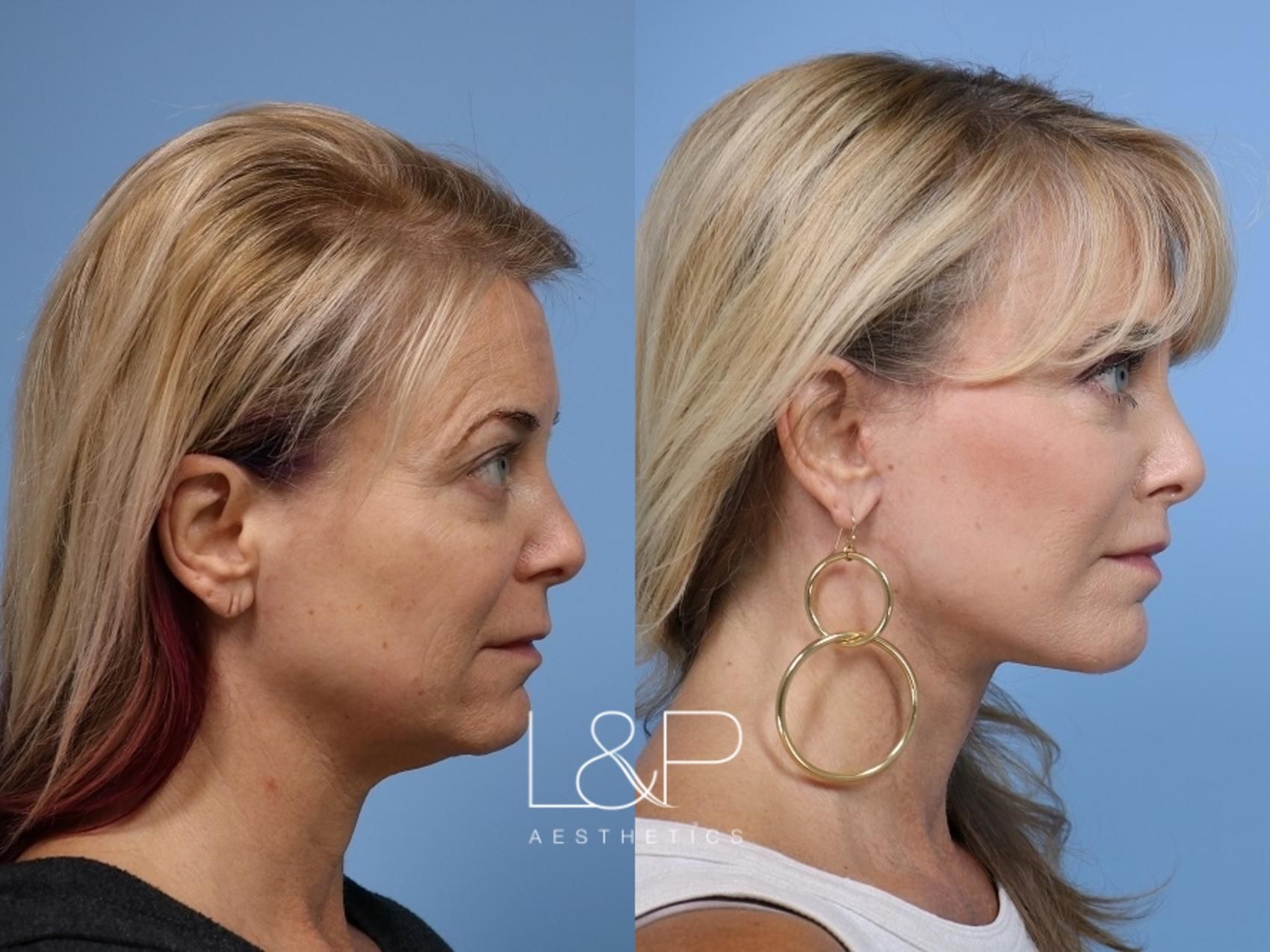 Facelift Neck Lift before and after treatment