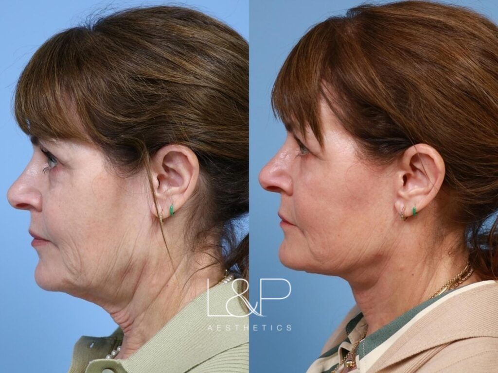 Facelift Neck Lift before and after treatment