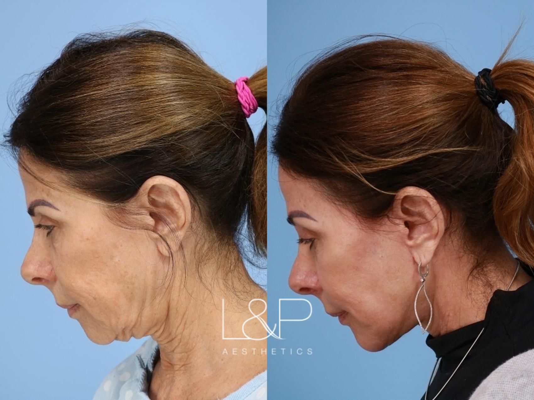 Facelift Neck Lift before and after treatment