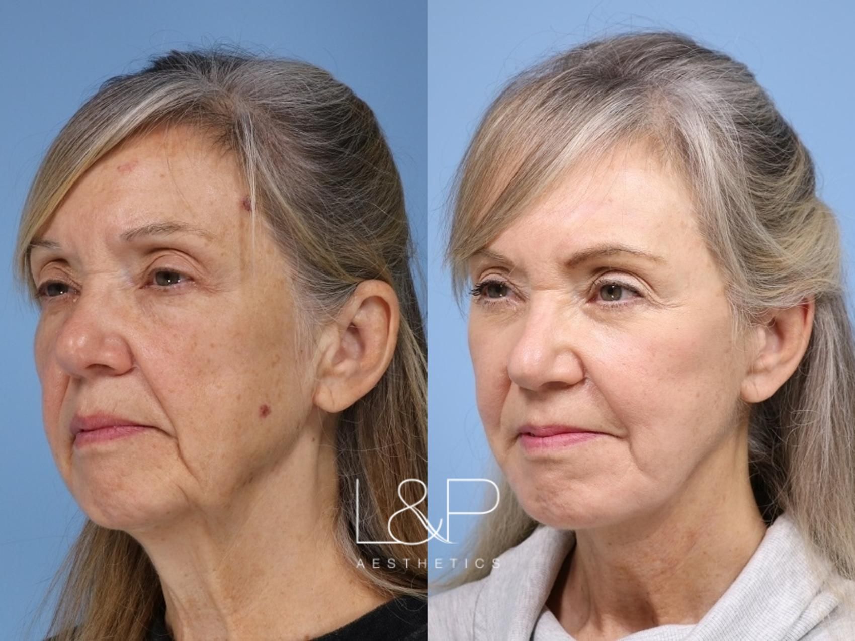 Facelift Neck Lift before and after treatment