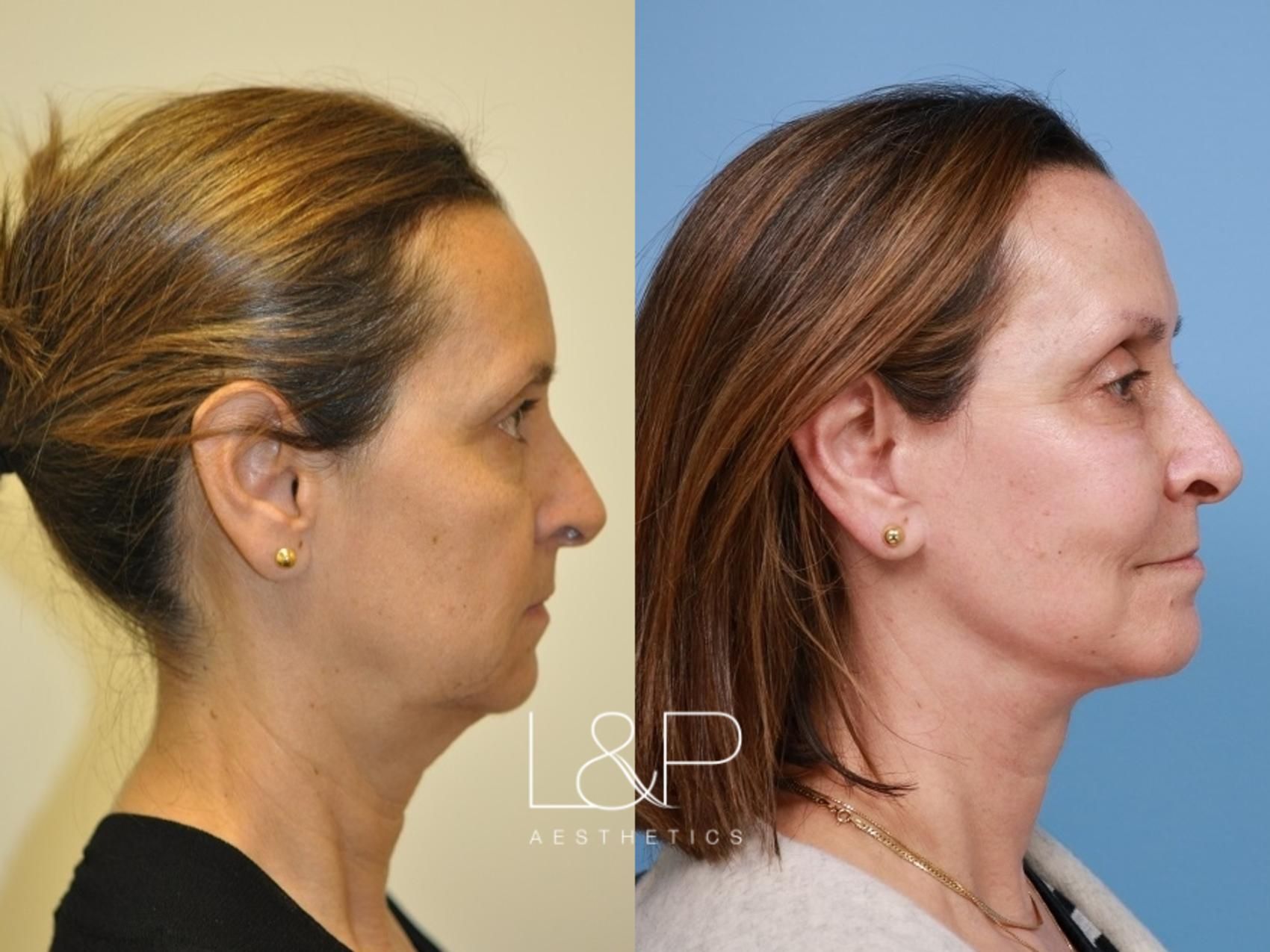 Facelift Neck Lift before and after treatment