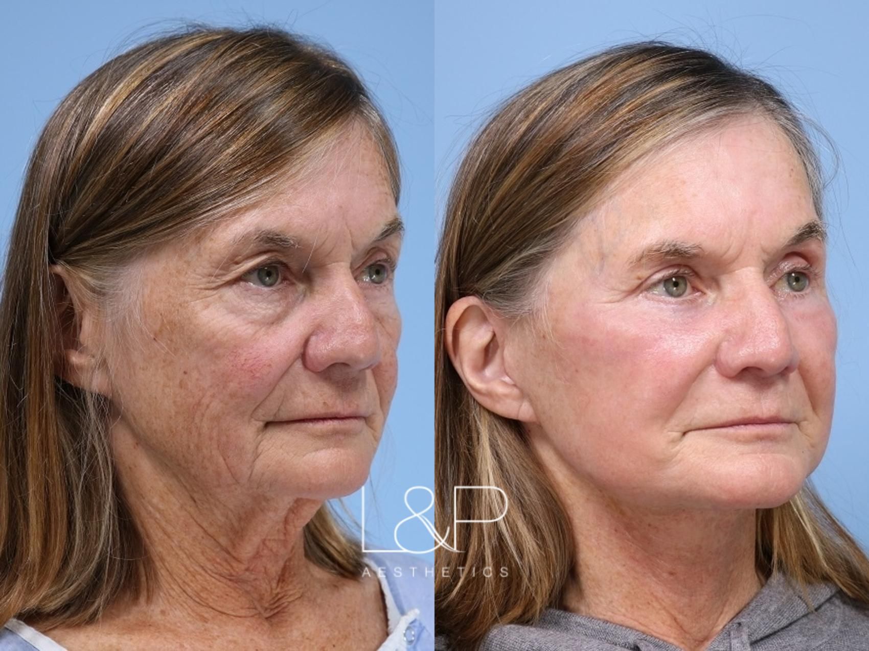 Facelift Neck Lift before and after treatment