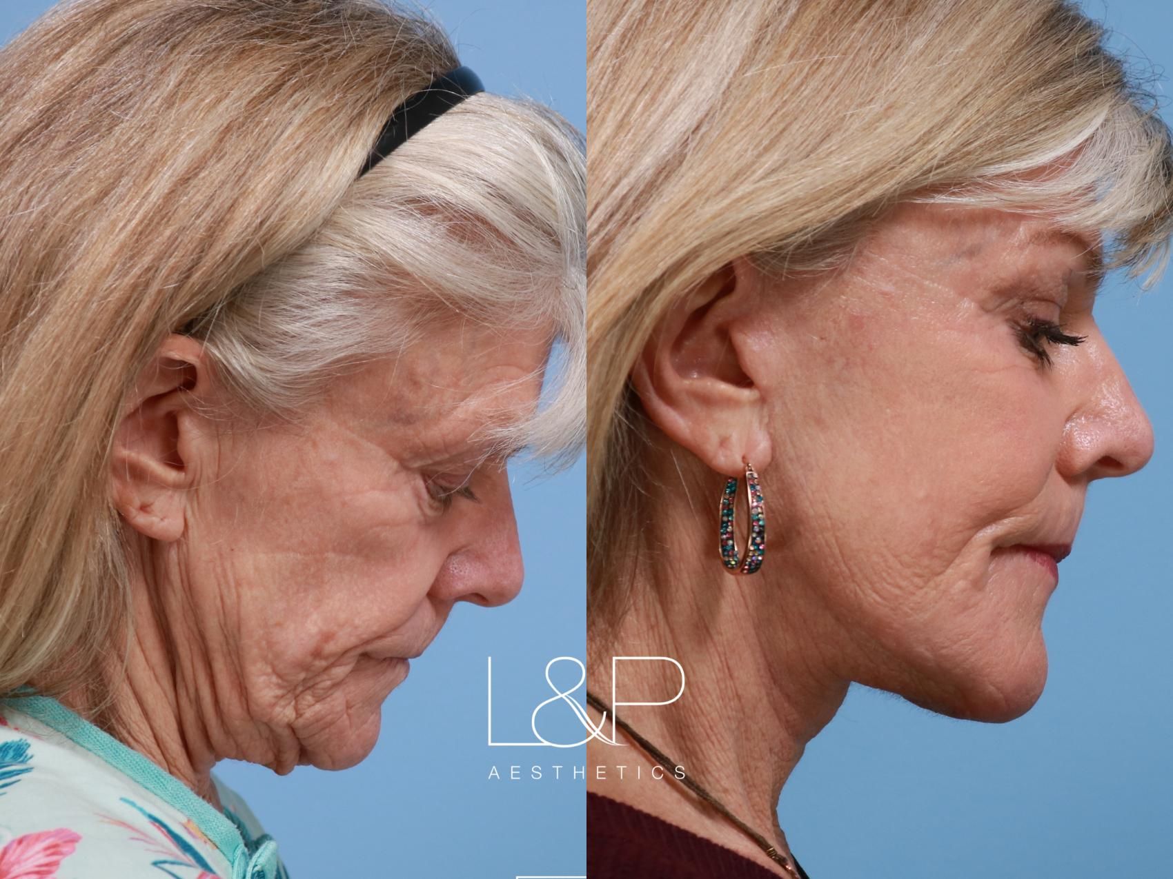 Facelift Neck Lift before and after treatment