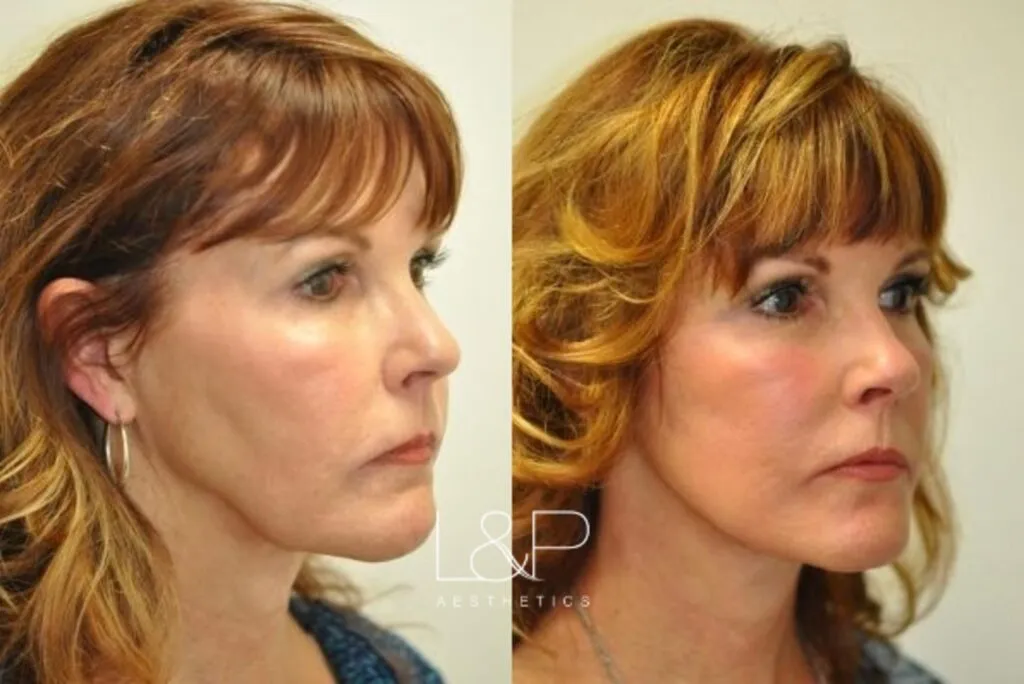 Facelift & Neck Lift Before And After L&P Aesthetics