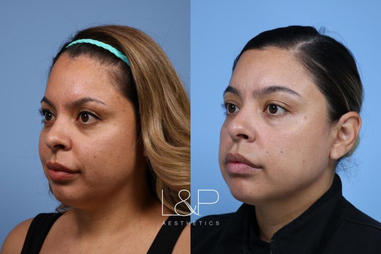 Facetite / Accutite Before and after treatment