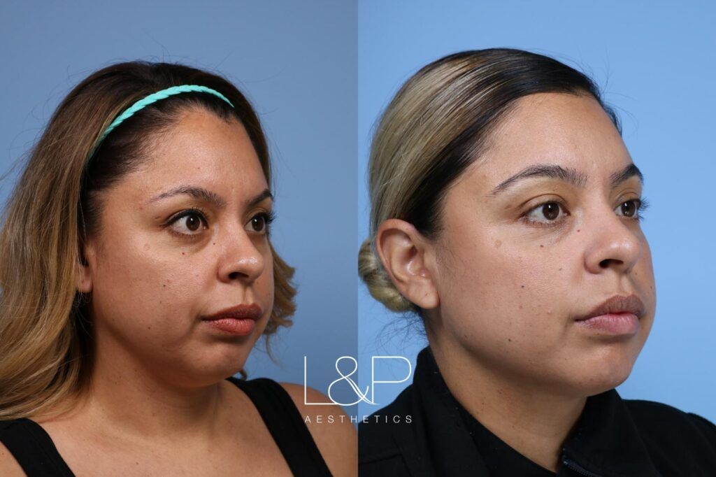 Facetite / Accutite Before and after treatment