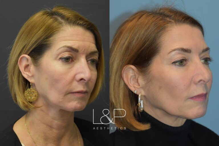 Facial Fillers before and after treatment