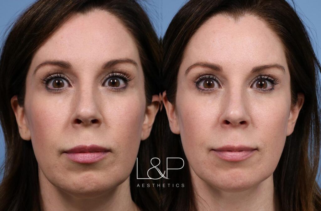 Facial Fillers before and after treatment