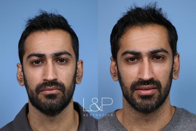 Facial Fillers before and after treatment