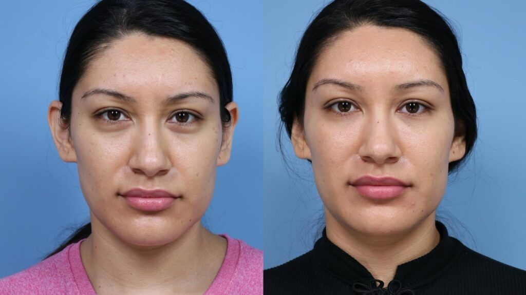 Facial Fillers before and after treatment