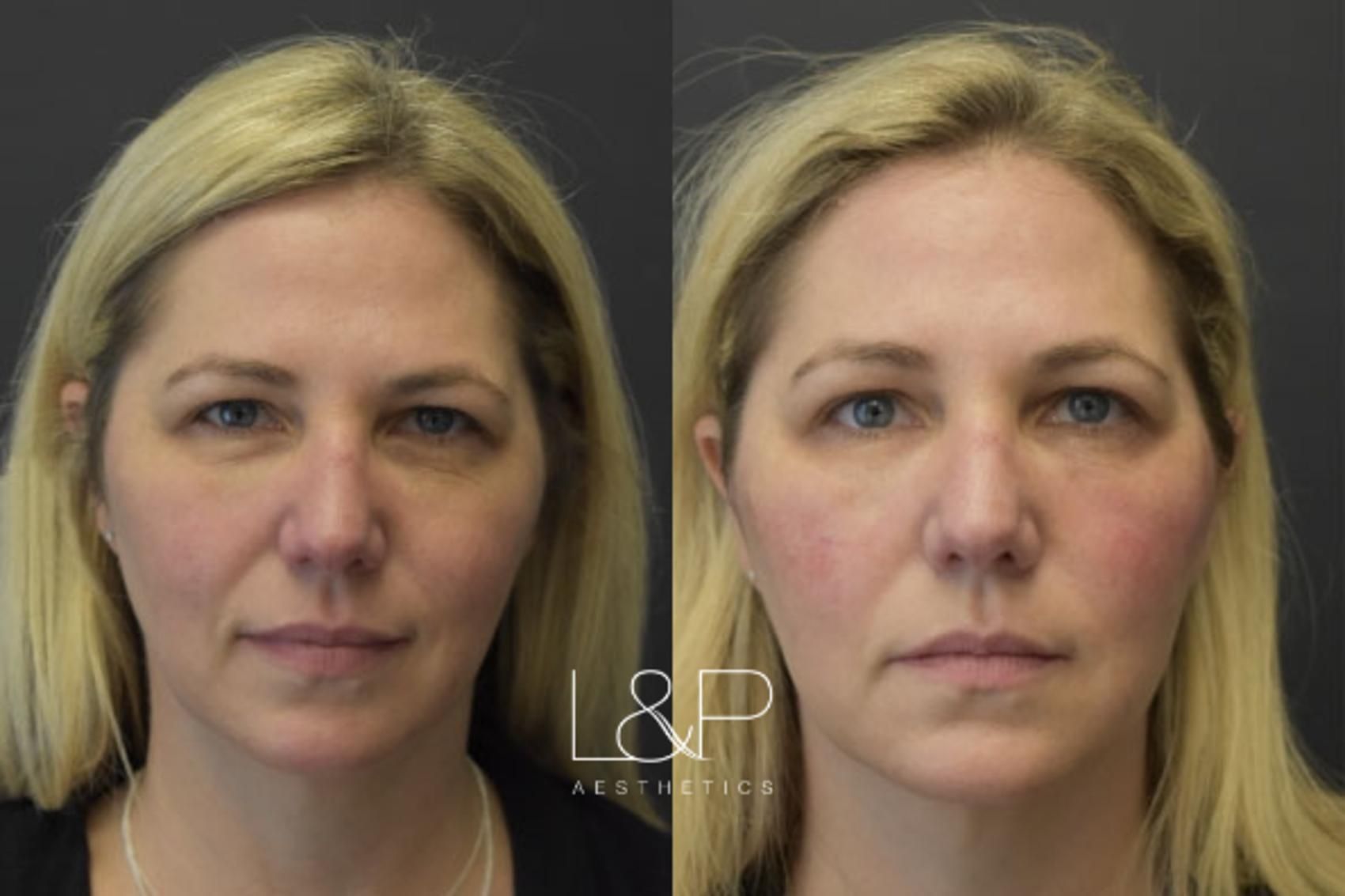 Facial Fillers before and after treatment