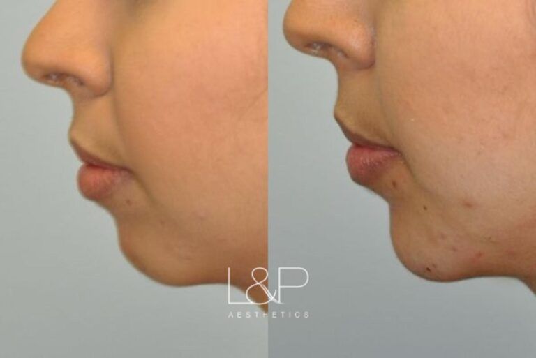 Facial Fillers before and after treatment