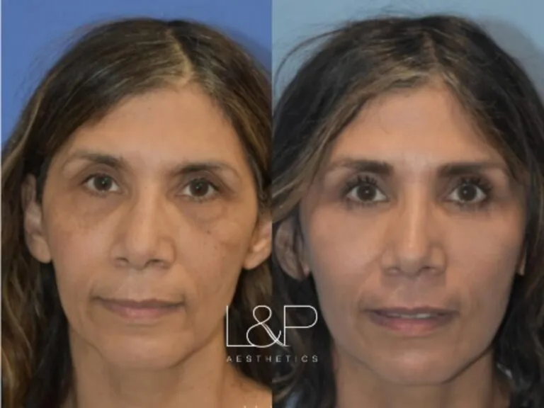 Fat Transfer before and after treatment in Los Gatos, California