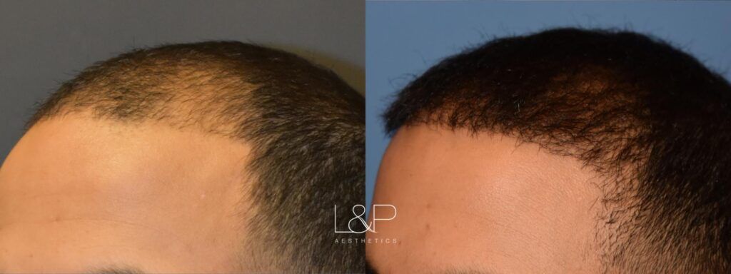 Hair Restoration before and after treatment