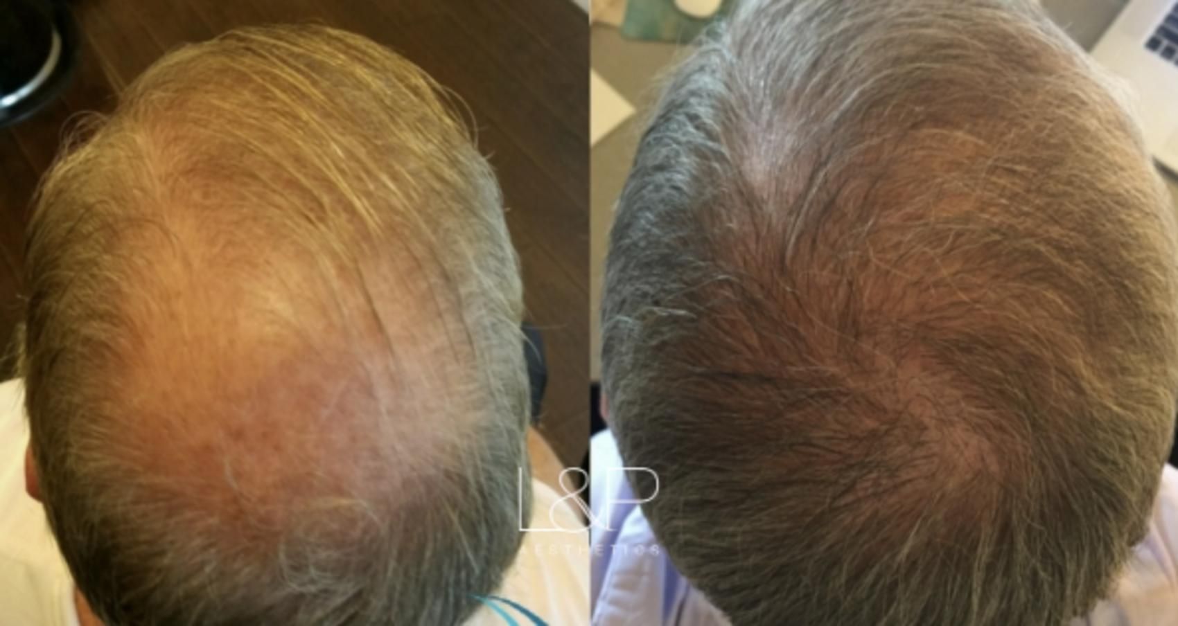 Hair Restoration before and after treatment